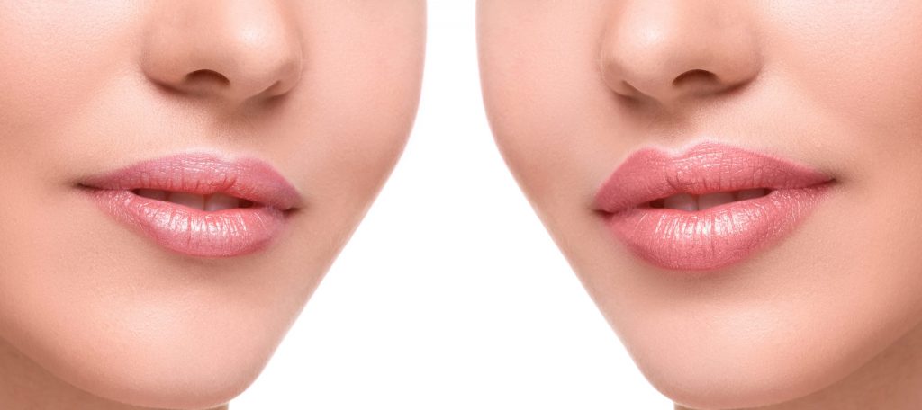 acide hyaluronique lèvres injections