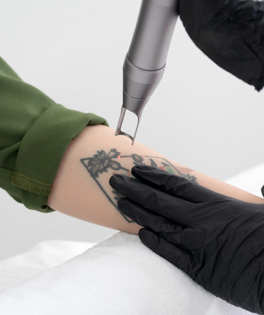 Enlever son tatouage ua laser au Centre Victoire Haussmann